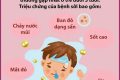 TUYÊN TRUYỀN PHÒNG CHỐNG BỆNH SỞI TUYÊN TRUYỀN PHÒNG CHỐNG BỆNH SỞI